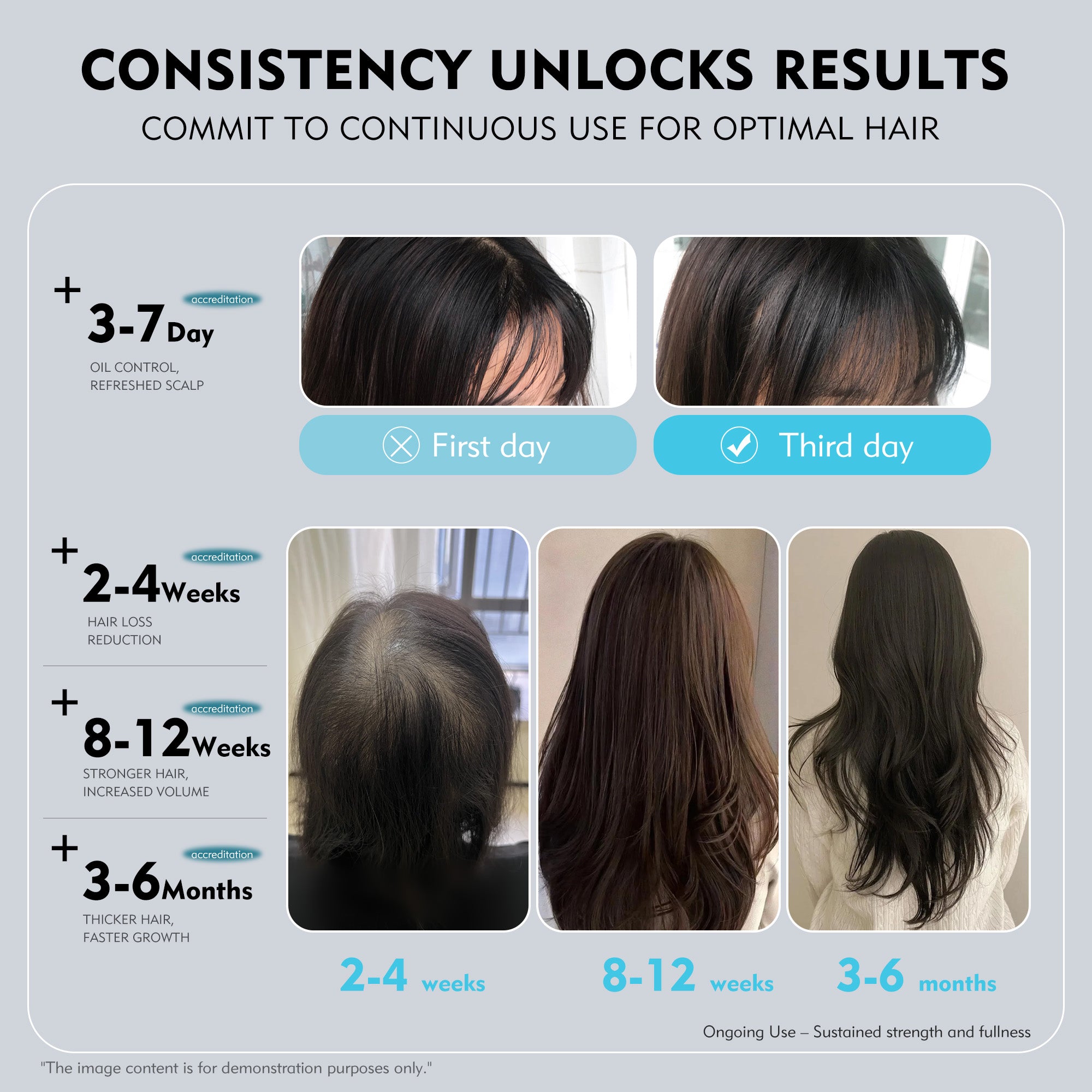 KOSHINÉ 0.5% KX-826 Anti-Hair Loss Solution is suitable for androgenic hair loss and can be used by both men and women( Blue Bottle)