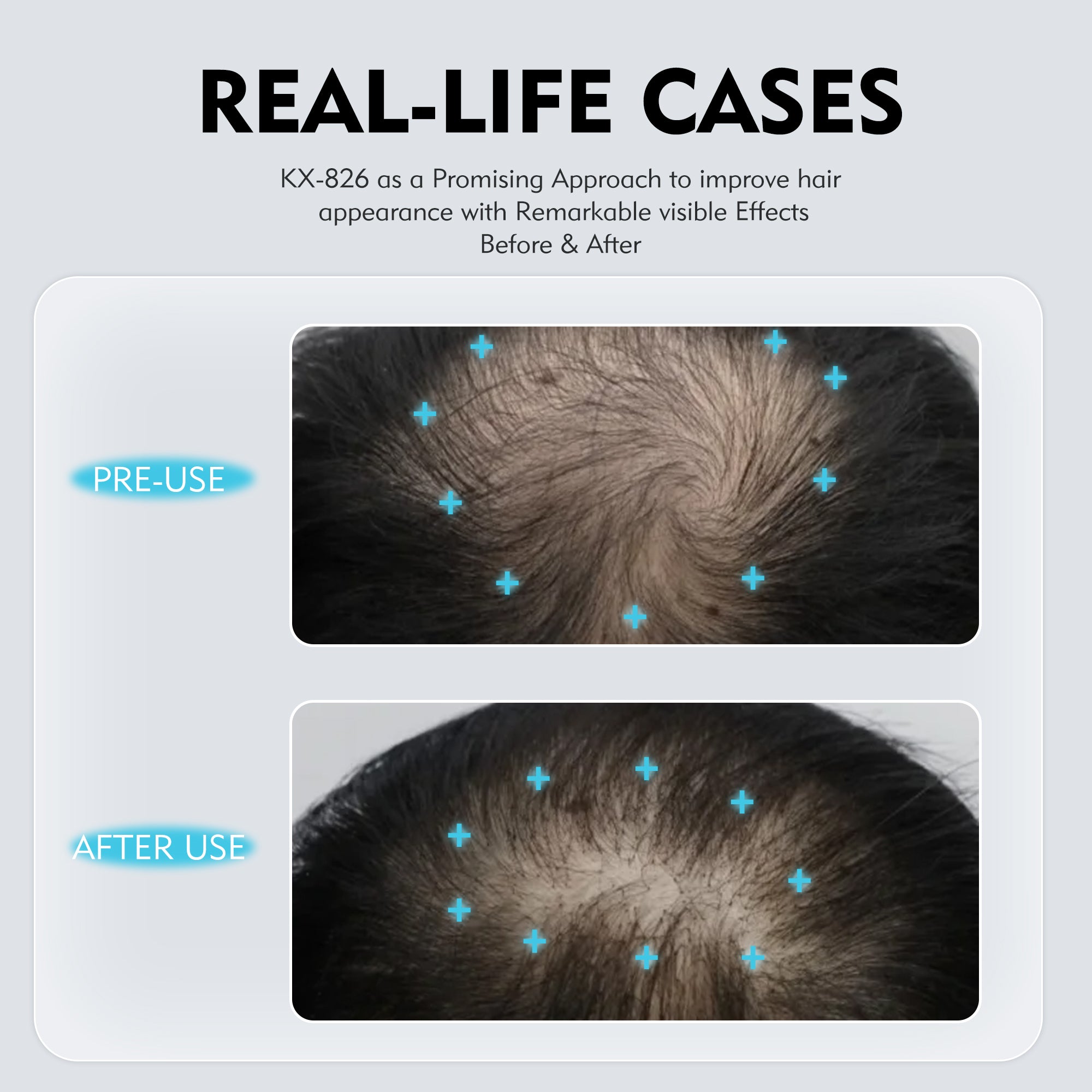 KOSHINÉ 0.5% KX-826 Anti-Hair Loss Solution is suitable for androgenic hair loss and can be used by both men and women( Blue Bottle)