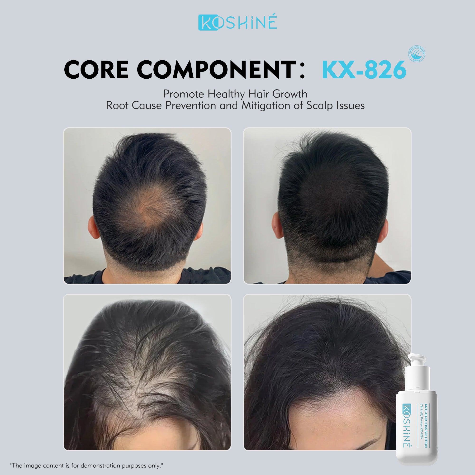 KOSHINÉ 0.5% 826 Anti-Hair Loss Solution is suitable for androgenic hair loss and can be used by both men and women（3 bottles）
