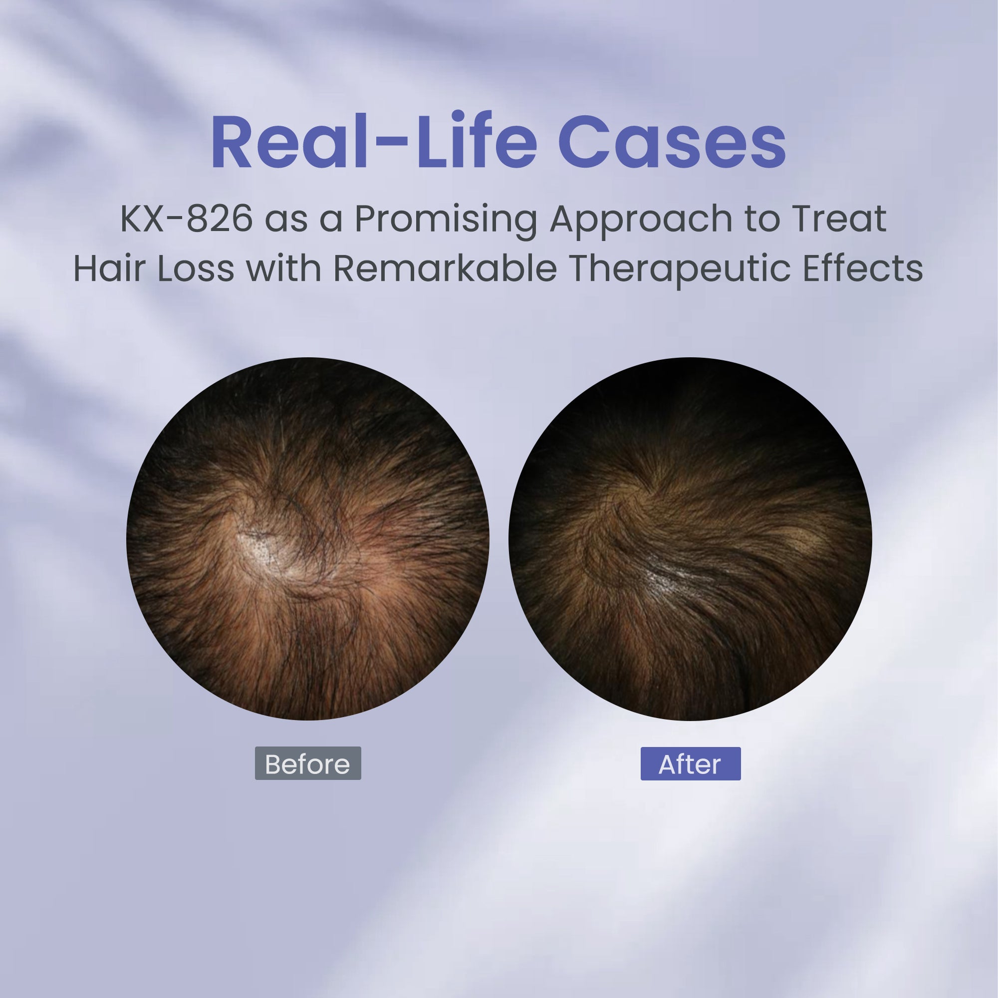 KOSHINÉ 0.9% 826 DHT Blocker Hair Thickening Growth Products （Purple Bottle）